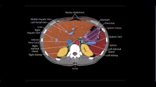 Normal Abdomen anatomy on a CT Scan Simplified: Real CT Images | Radiology Illustration
