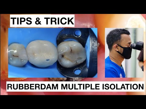 Tips and trick How To Place Rubberdam On Posterior Lower