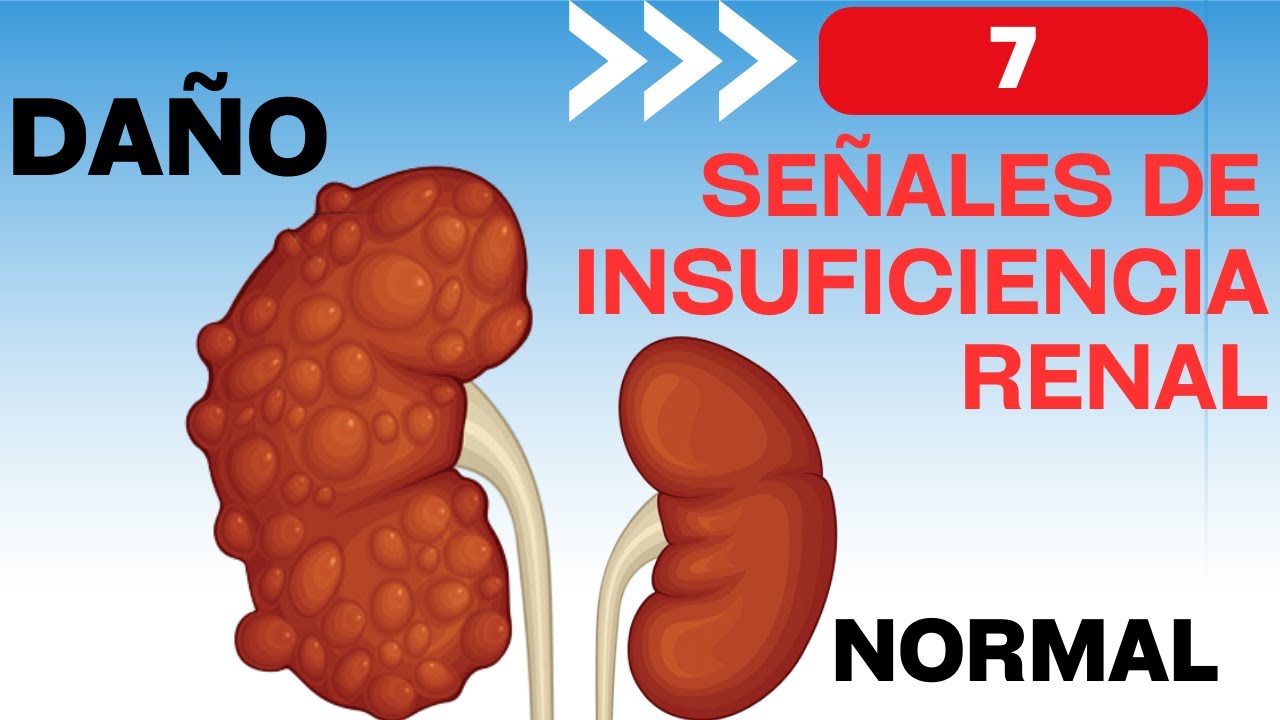 7 señales de que tendrás insuficiencia renal