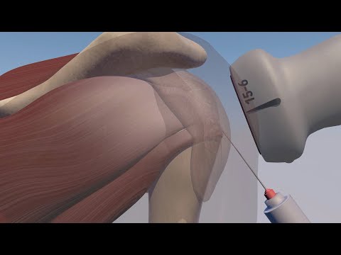 Ultrasound Guided Subacromial Injection 3D Model & Animation
