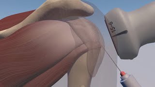 Ultrasound Guided Subacromial Injection 3D Model & Animation