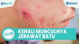 Mengenal Jenis Jerawat Batu pada Kulit Wajah, Disebabkan oleh Infeksi hingga Peradangan