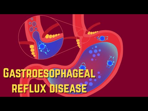 Gastroesophageal Reflux Disease (GERD) - CRASH! Medical Review Series