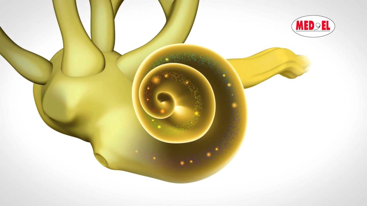 Video explicativo sobre la Perdida Auditiva Neurosensorial | MED-EL