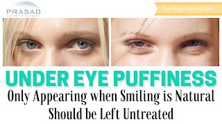 Puffiness Under Eyes that Only Appears When Smiling Does Not Need Cosmetic Treatment