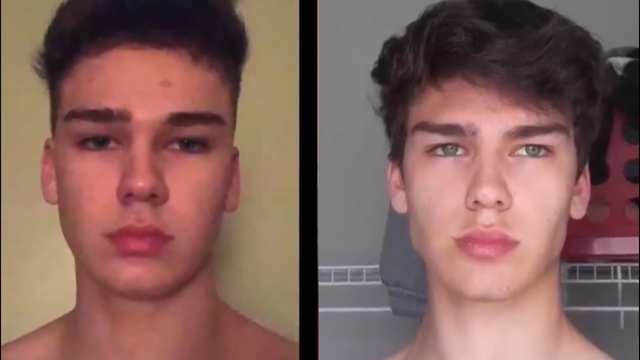 My Mewing Transformation! (16 - 20)