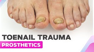 Toenail Trauma | Toenail Removal & Cleanup