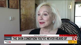 Health Spotlight: The skin condition you