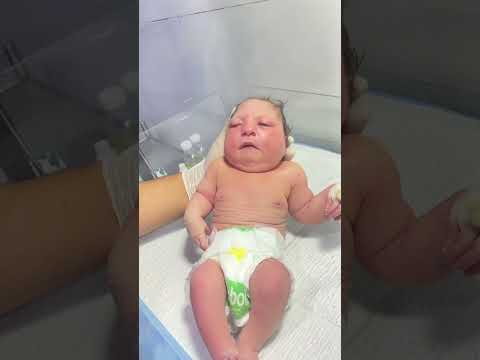 Down Syndrome and Microcephalic Baby in NICU | Admitted for Nursing Care & NICU Protocol #neonatal