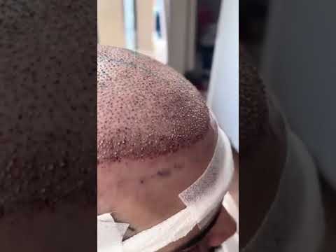 Testimonianza paziente Amantide