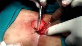 Pilonidal Cyst Tail Bone Surgery (пилонидальная киста хирургия копчик)