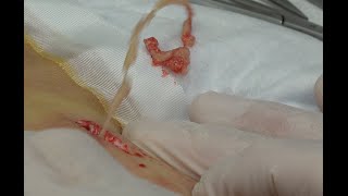 Bruce Infected Cyst, Double Super Slo-Mo!