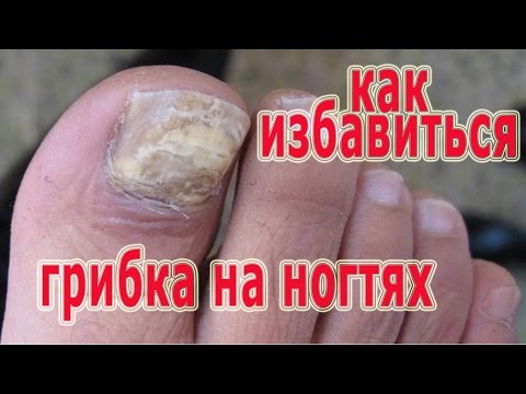 Die Behandlung gribka der Nägel der Beine in den Volksweisen Gribok die Füsse, für Mal zu heilen