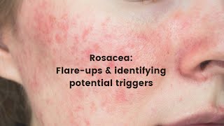 Rosacea flare ups and identifying potential triggers