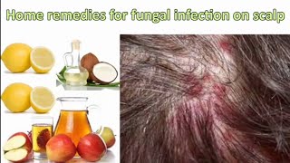 HOME REMEDIES FOR FUNGAL INFECTION IN SCALP | Rowena Leyte