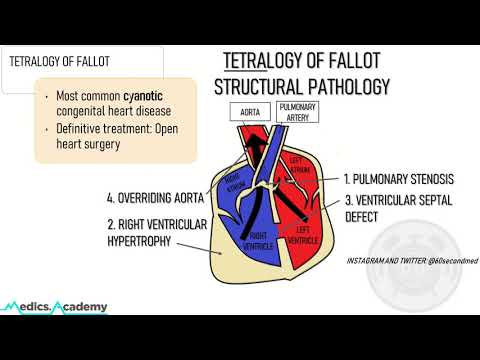 54 SECONDS on the STRUCTURAL PATHOLOGY in TETRALOGY OF FALLOT (A way to finally remember this!)