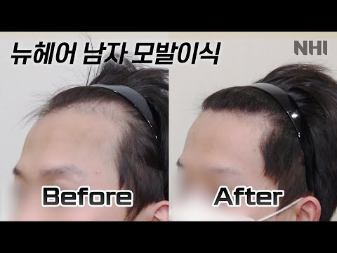 절개 남자 모발이식 1800모낭(3600모) 1년 경과 I 뉴헤어 I Before&After [모발이식][모발이식후기]