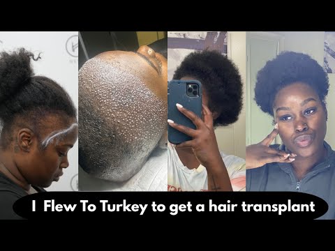 I FLEW TO TURKEY TO GET A HAIR TRANSPLANT | HEVA CLINIC | BLACK WOMEN  | FUE | MY JOURNEY | MY STORY