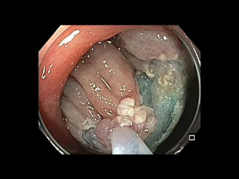 Colonoscopy: Cecum - Flat Lesion - EMR