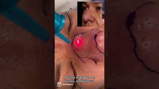 Using *Lasers* to Reshape a Nose (Remove Enlarged Pores)