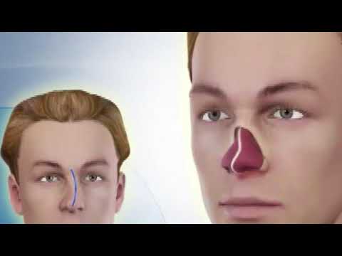 Rinoplastika՝ քթի վիրահատություն, ռինոպլաստիկա, ринопластика, ճանաչեք ամենահմուտ մասնագետին