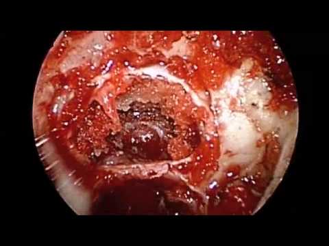 Endoscopic Removal of Pituitary Tumor Followed by Reconstruction