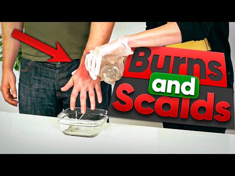 Burns and Scalds - First Aid Training
