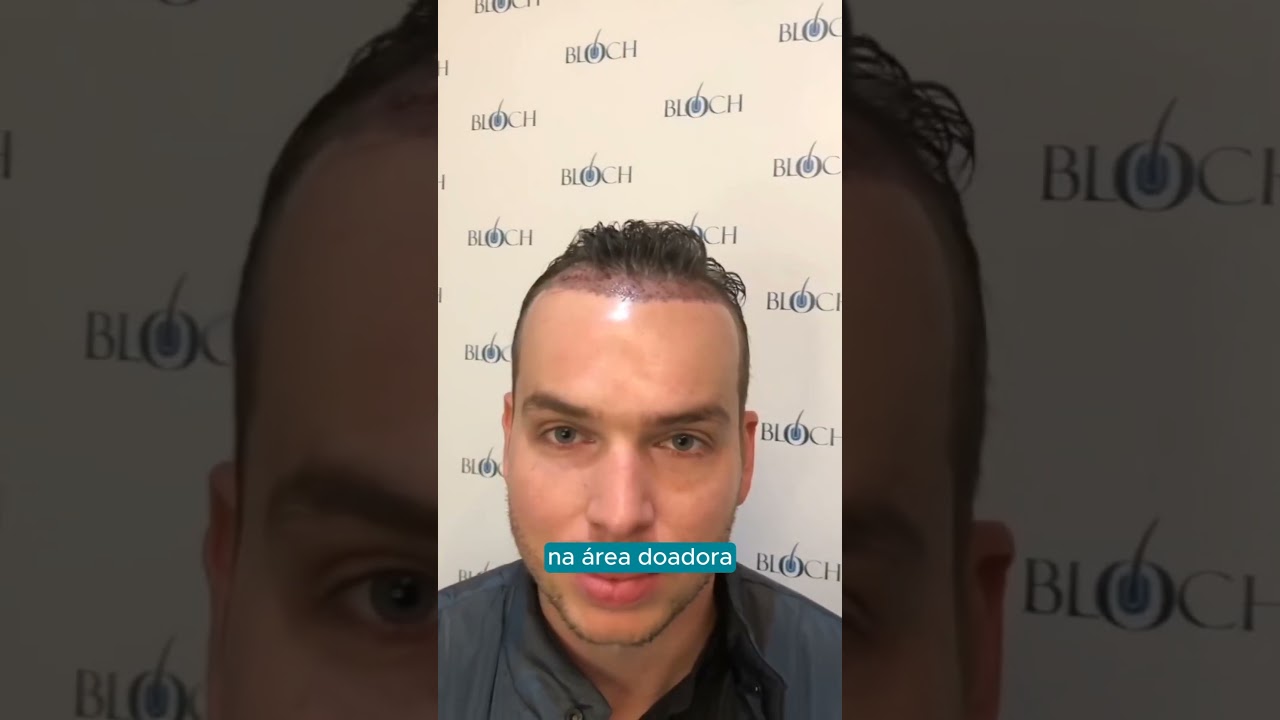 Transplante capilar sem raspar todo o cabelo - Dra. Leila Bloch #transplantedecabelo
