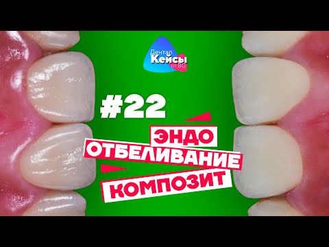 Эндо, отбеливание, композит | Дентал Кейсы от BG #22