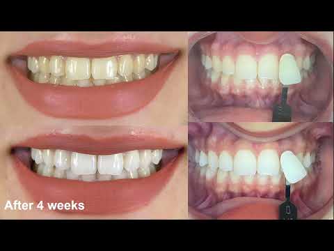 Webinar: Simplified Approach to Direct Composite Veneers - Dr. Osama Shaalan 8.1.25 Replay