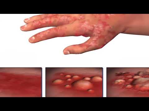 Brodo a dermatite atopic Dezloratadin atopic dermatite