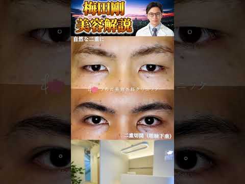 医学科 皮膚が厚いタイプの方の埋没法は不向き！？ #うめだ美容外科クリニック #二重