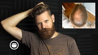 The Biggest Mistake When Dealing with Hair Loss