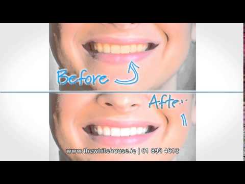 Teeth Whitening Edinburgh - The White House