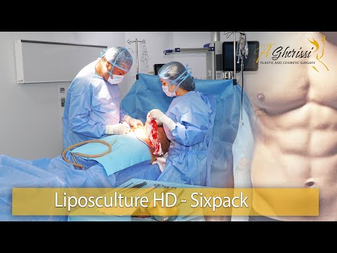 Liposculpture Abdominoplastie chez un homme