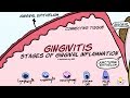 Gingivitis: Stages of Gingival Inflammation