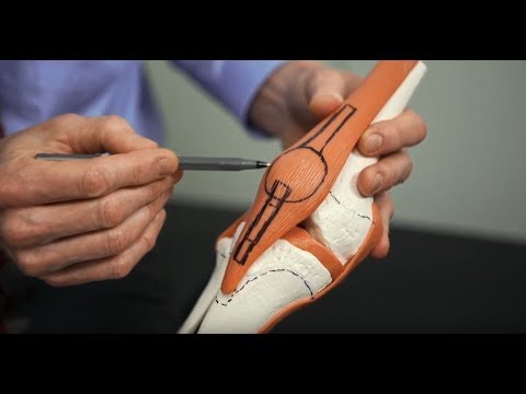 How do I choose a graft for ACL reconstruction? - Stanford Children's Health