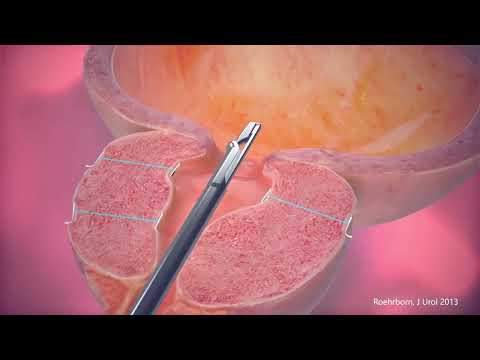 The UroLift System - Animation Video (ENGLISH)