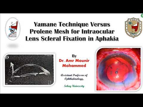 Proline Mesh in Aphakia