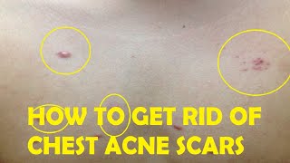 how to get rid of chest acne scars fast and easy