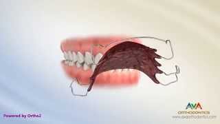preview picture of video 'Orthodontic Retainers: Hawley, Clear and Permanent'