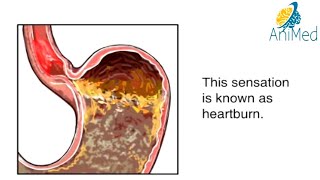 How Heartburn Works Animation -Acid Reflux Disease Symptoms Causes & Treatments Video GERD Explained