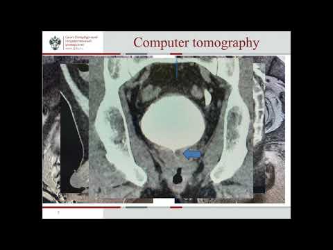 #23431 Lower urinary tract symptoms (LUTS) caused by organic pathology mostly affect males over ...