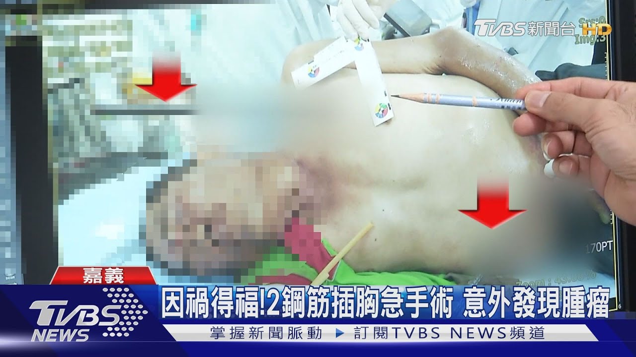 因禍得福!2鋼筋插胸急手術 意外發現腫瘤