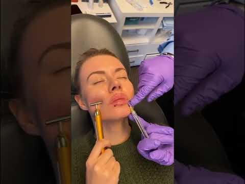 Lip Augmentation