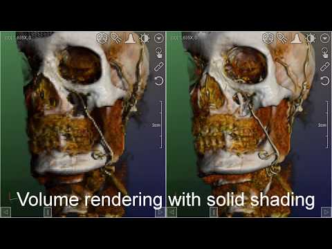 DroidRender - 3D DICOM viewer Video