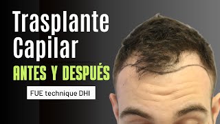 TRASPLANTE CAPILAR SIN RAPAR - 2.350 UF's - Dr. Álvarez