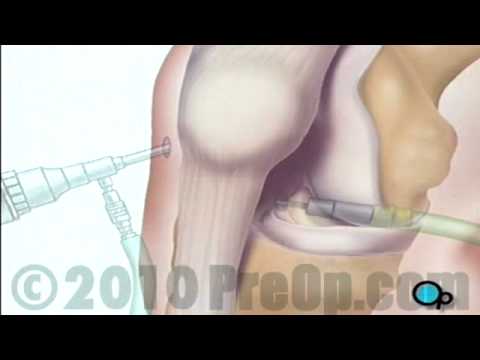 Anterior Cruciate Ligament Arthroscopic Repair Surgery