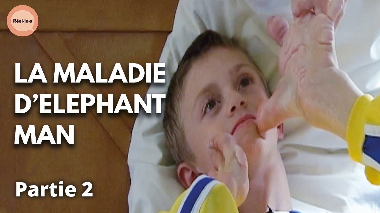 Syndrome D’Elephant Man Traitement – QNANCK