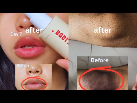 Seoul 1988 Retinal Serum Review | Results in 7 Days Using Seoul 1988 Eye cream to lighten the Lips